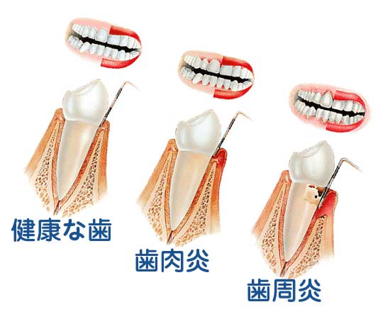 健康な歯 歯肉炎 歯周病