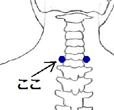 第六頸椎点