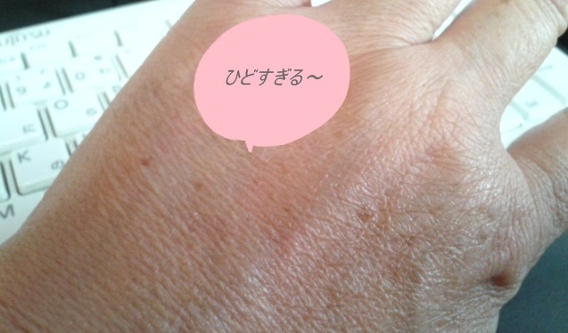 手の甲20141015左