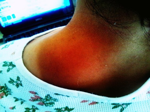 Sunburn_01.jpg