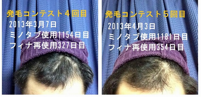 発毛②