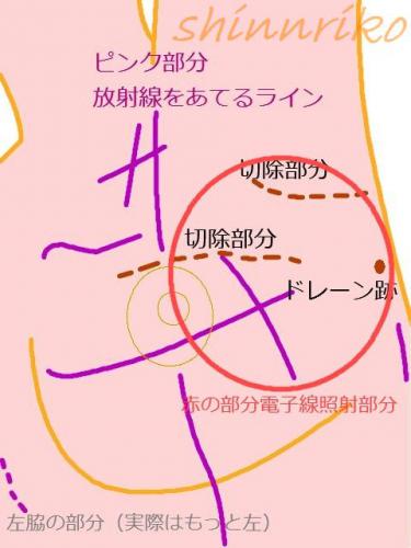 放射線・電子線治療ライン