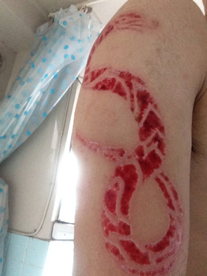 スカリフィケーション スキンリムーバル カッティング cutting Scarification
