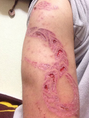 スカリフィケーション スキンリムーバル カッティング cutting Scarification